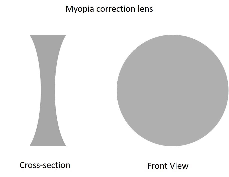 myopia lens diagram
